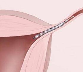 Essure